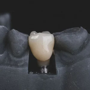 Implanty stomatologiczne – nowoczesne rozwiązanie dla zdrowego i pięknego uśmiechu